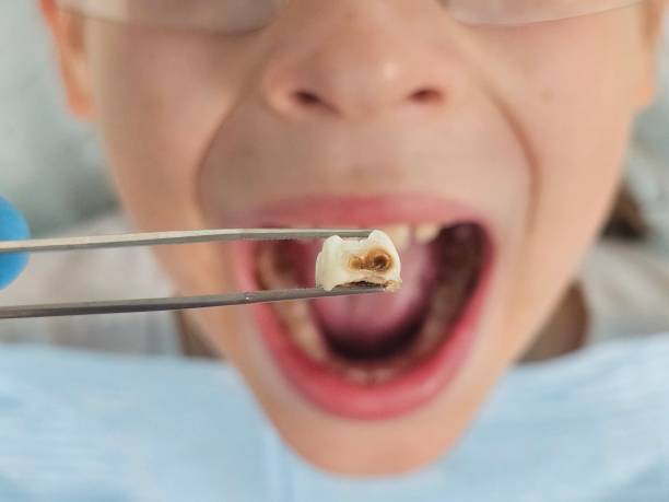 Best Emergency Wisdom Teeth Removal in Platteville, CO